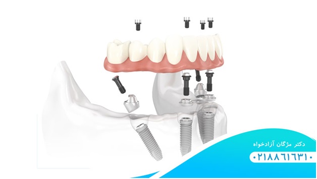 آشنایی با انواع روش های ترمیم دندان