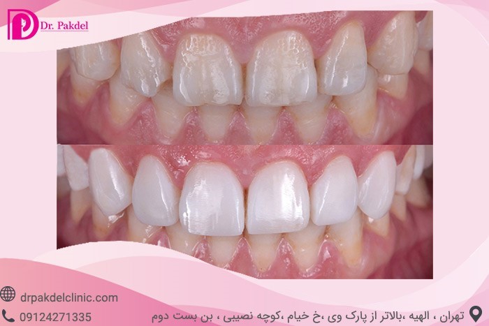 Dental composite-9