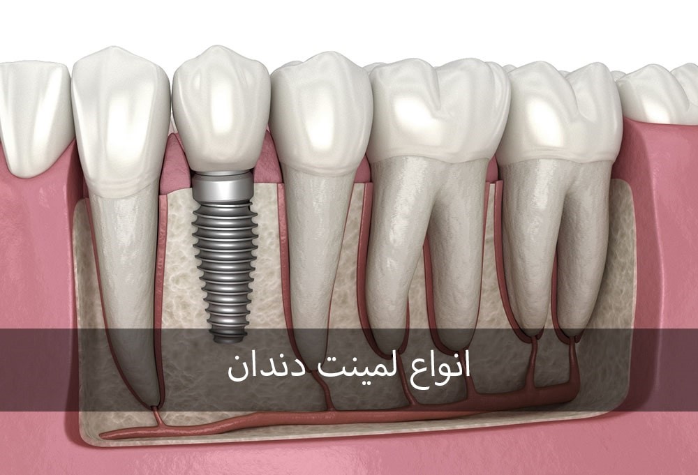 ایملپنت دندان و عوارض آن