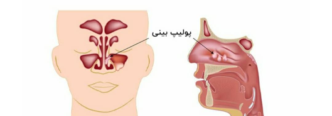 عوارض رایج بعد از عمل بینی