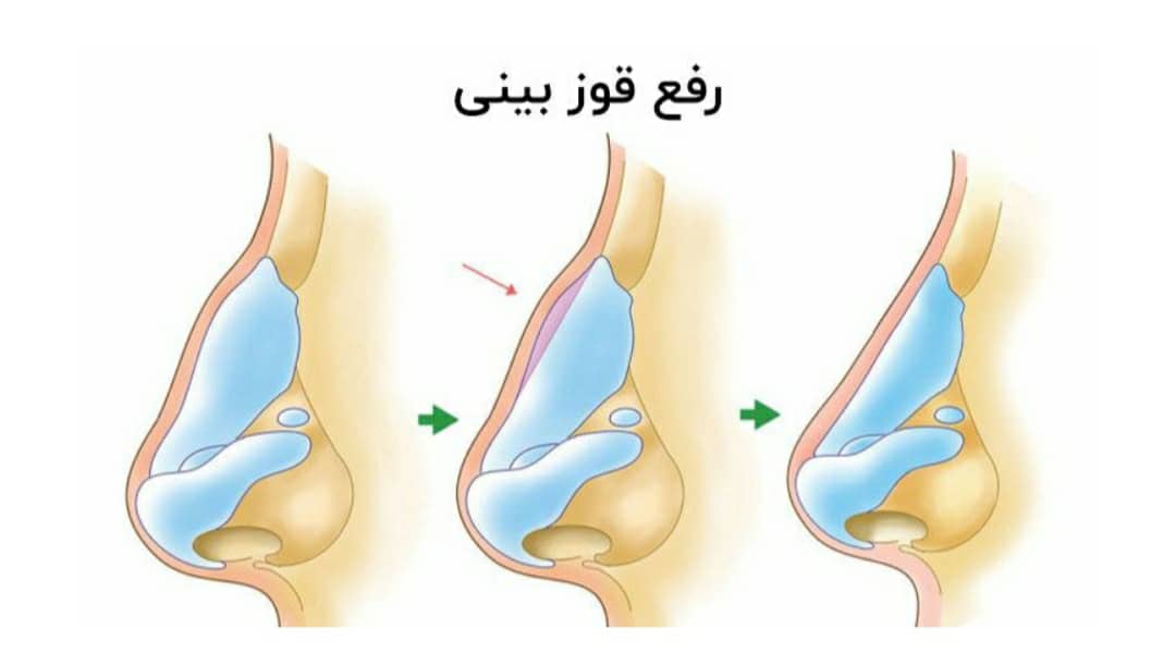 عوارض رایج بعد از عمل بینی