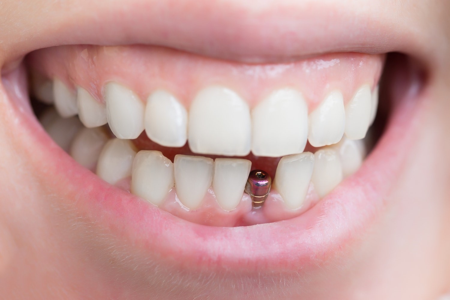 آشنایی با روش های کاشت دندان