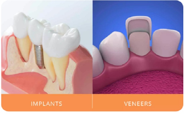 ایمپلنت دندان یا لمینت؟ کدام یک نتیجه بهتری دارد؟