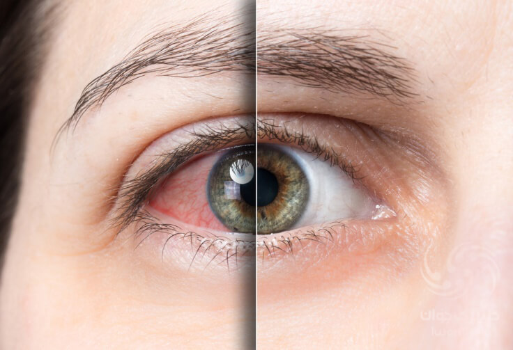 علائم بیماری خشکی چشم و كشف يك درمان جديد