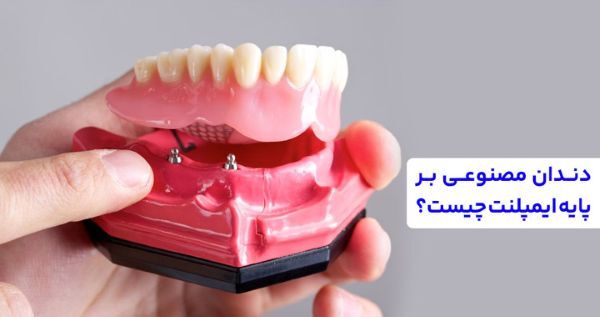 دندان مصنوعی بر پایه ایمپلنت؛ راه‌حلی مدرن برای لبخندی جذاب