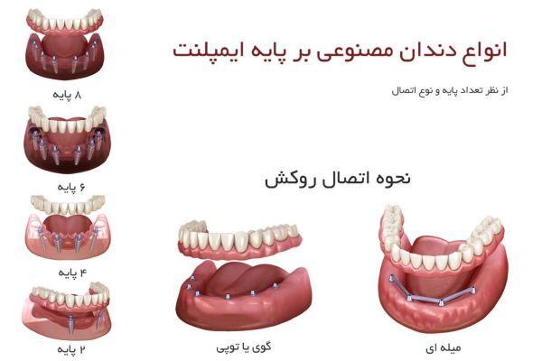 دندان مصنوعی بر پایه ایمپلنت؛ راه‌حلی مدرن برای لبخندی جذاب