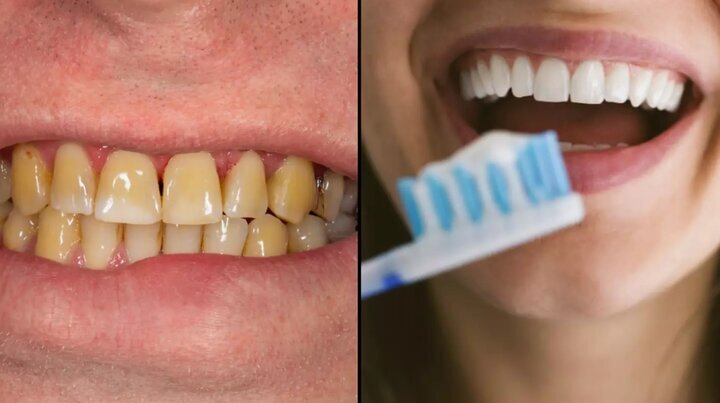 چرا دندان‌ها زرد می‌شوند و چه باید کرد؟