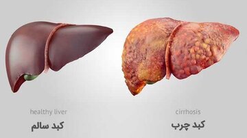 خوراکیهای مفید و مضر برای کبد را بشناسید