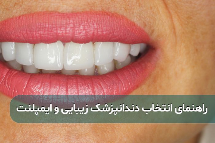راهنمای جامع انتخاب بهترین دندانپزشک مشهد برای لمینت و ایمپلنت