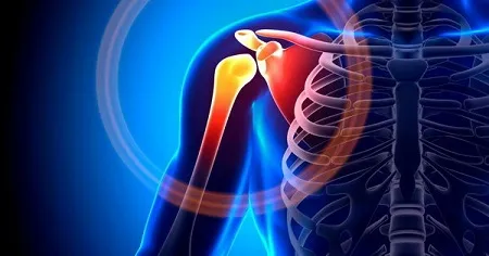 شانه یخزده چیست؟ + درمان شانه یخزده چیست؟ + درمان